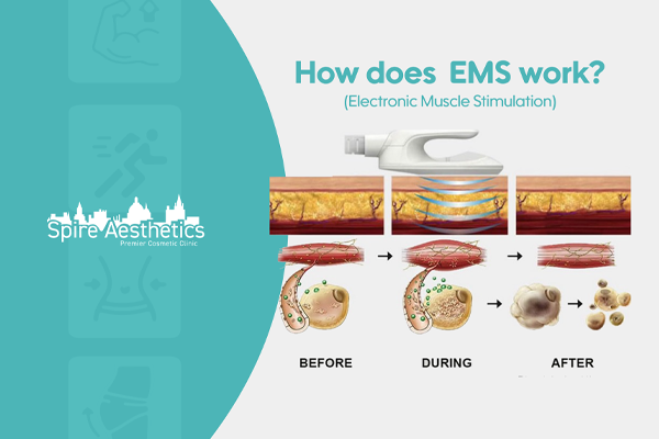EMS treatment for post pregnancy weight loss treatment Bridgend