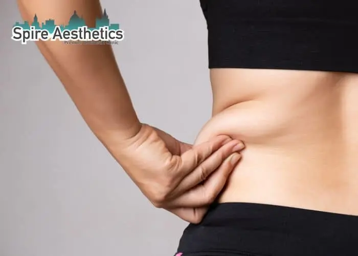 Image of woman pinching fat on their hips Bridgend. Fat Freezing treatment