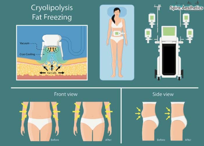 Image of diet and fat freezing combined for best results for Spire Aesthetics Bridgend