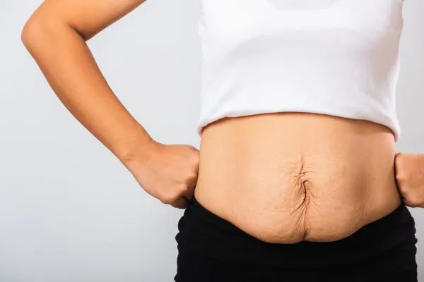 Image of a woman's stomach after weight loss with sagging skin following a gastric band Bridgend