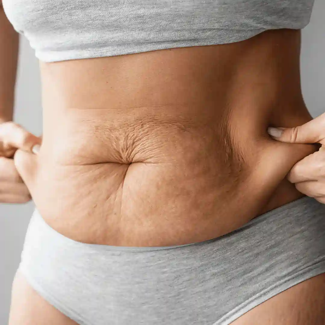 Is It Normal to Have Loose Skin After Pregnancy Bridgend?