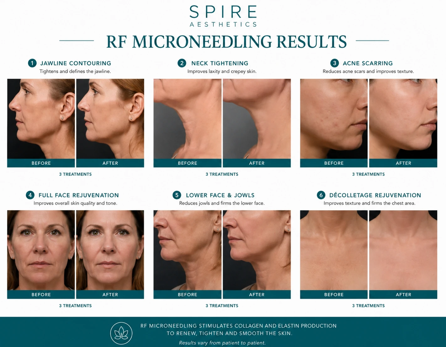 RF Microneedling Skin tightening Bridgend results