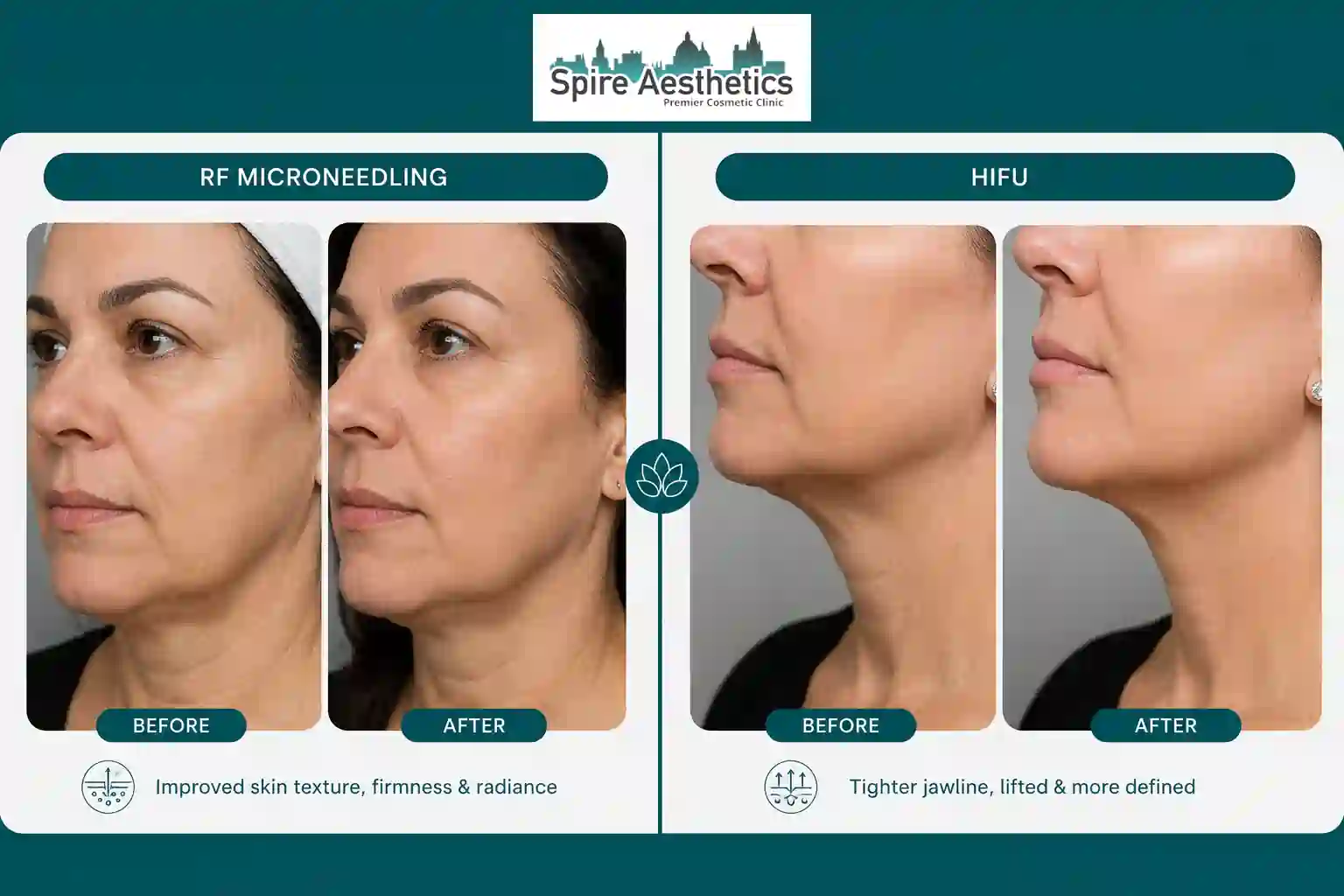 Can RF Microneedling and HIFU Be Combined Bridgend?