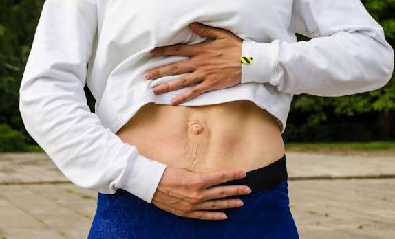 When Could Diastasis Recti Be the Missing Piece of the Puzzle Bridgend?