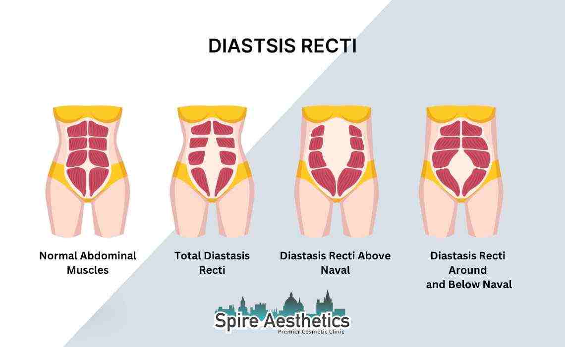 Is Non-Surgical Diastasis Recti Treatment Right for You? Common Concerns Answered Bridgend